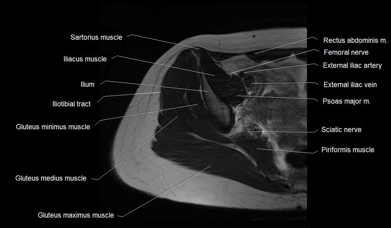MRI thigh cross sectional anatomy image 1.webp
